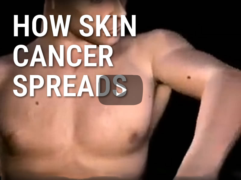 Video: How Skin Cancer Spreads